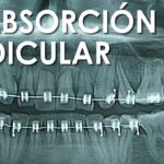 negligencia grave reabsorcuon grave por ortodoncia