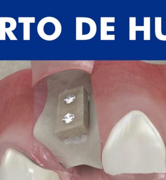 nivel de hueso alveolar indicaciones para ortodoncia