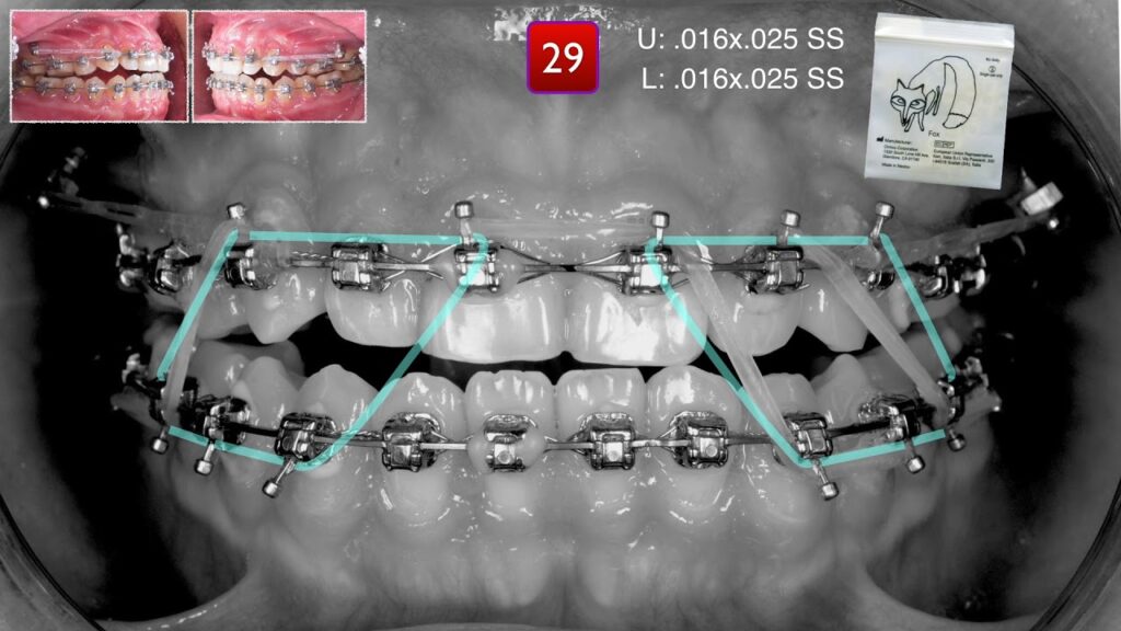 orthodontic finishing acabado ortodoncia