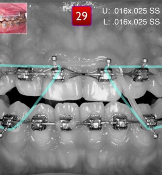 orthodontic finishing acabado ortodoncia