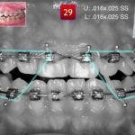 orthodontic finishing ortodoncia