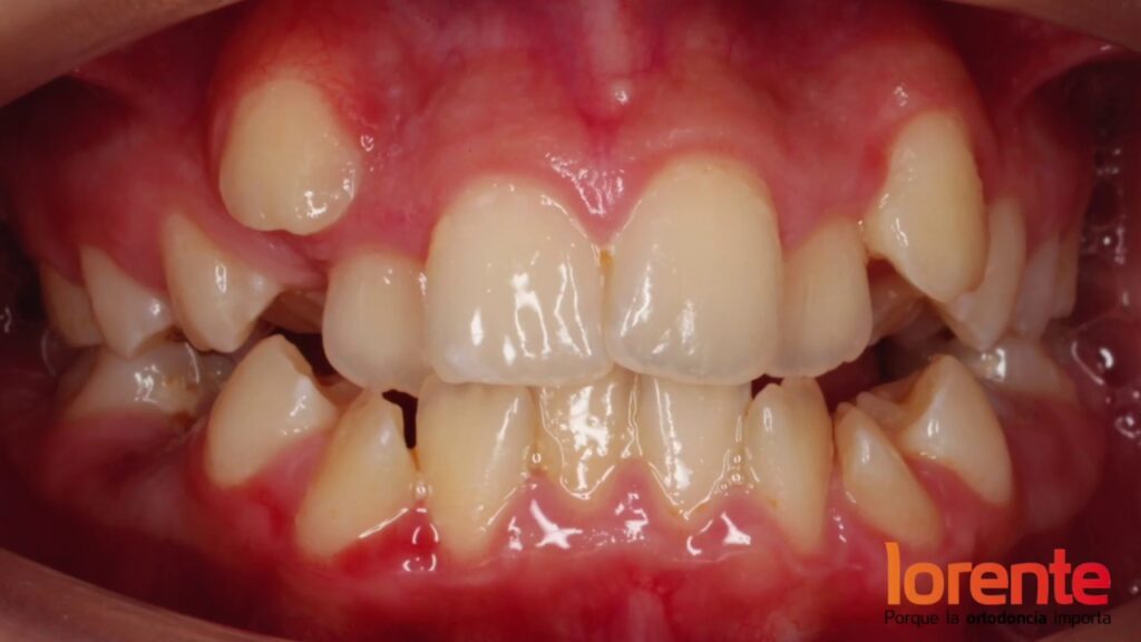 ortodoncia 14 meses antes y despues