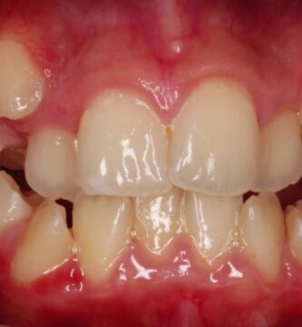 ortodoncia 14 meses antes y despues