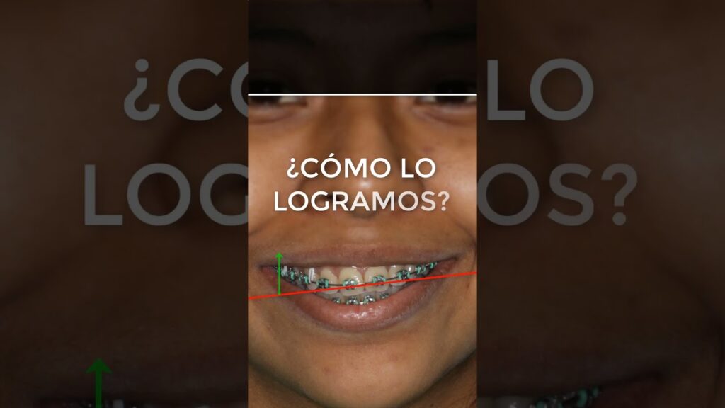 ortodoncia angulo inciso condilar de machorris