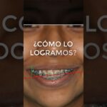 ortodoncia angulo inciso condilar de machorris