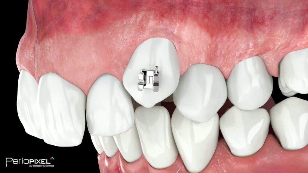 ortodoncia antes y despues en dientes pequeños