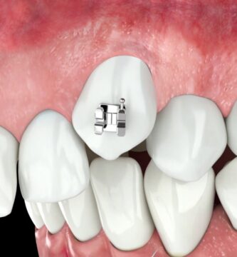 ortodoncia antes y despues en dientes pequeños