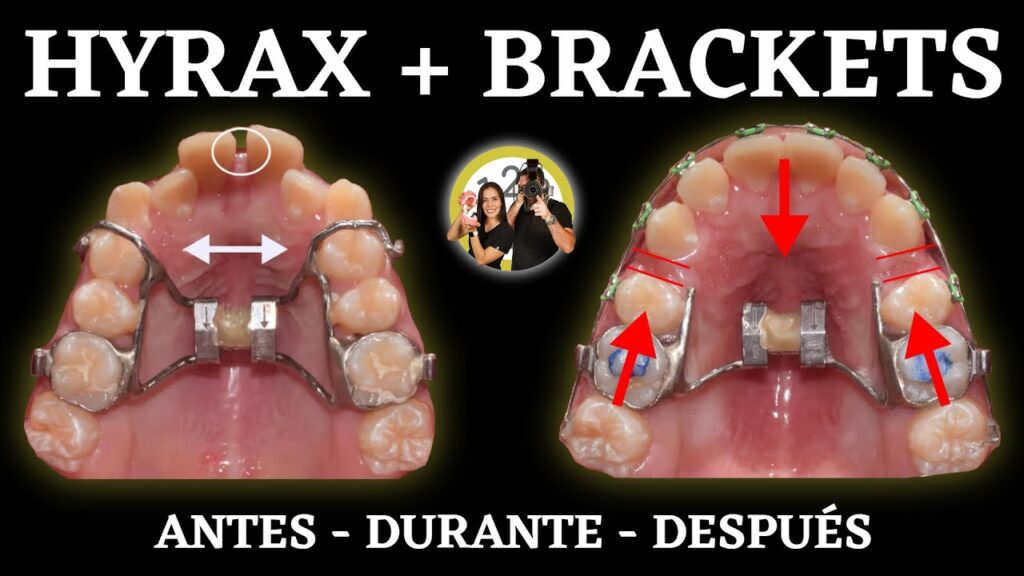 ortodoncia bracket superior