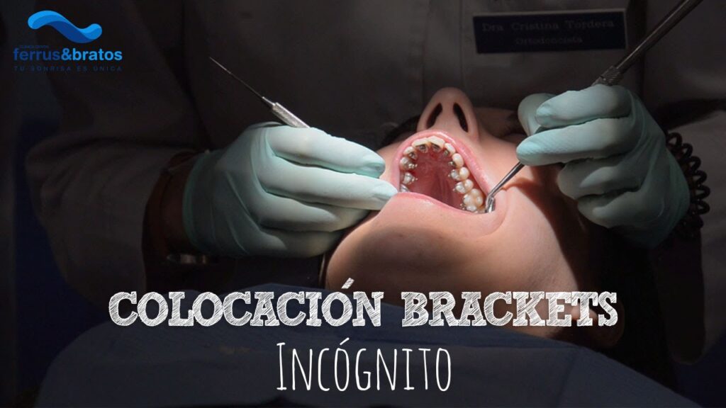 ortodoncia brackets internos