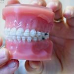 ortodoncia brakets ceramica