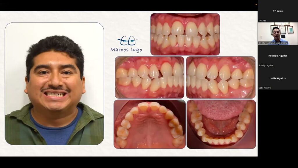 ortodoncia caida de brackets tip edge foro