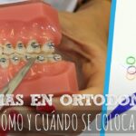 ortodoncia cambiar gomas al comer