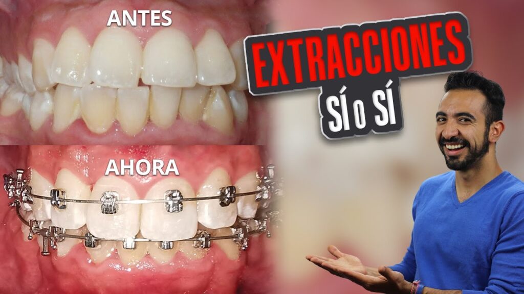 ortodoncia caso de extracciones dentales