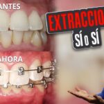 ortodoncia caso de extracciones dentales