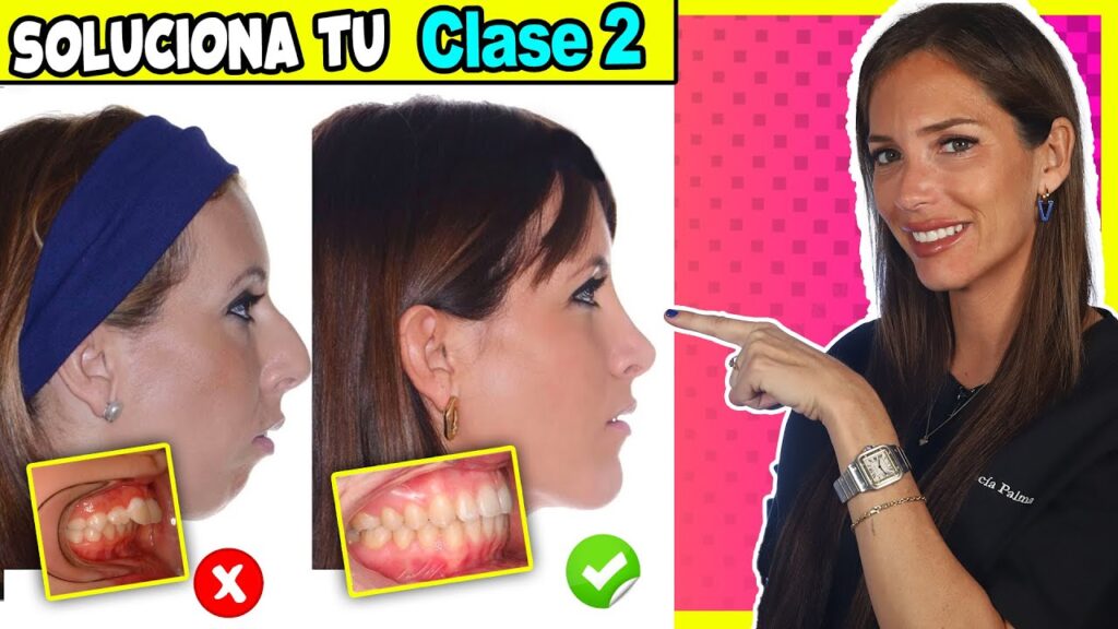 ortodoncia clase 2 antes y despues