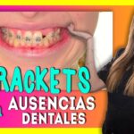 ortodoncia con dientes faltantes