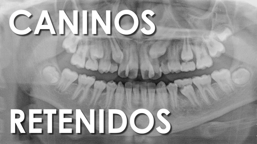 ortodoncia dientes delanteros diente que no baja