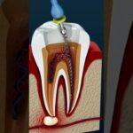 ortodoncia dientes endodonciados fundas