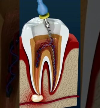 ortodoncia dientes endodonciados fundas