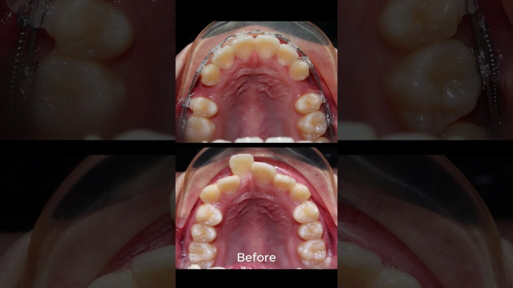 ortodoncia e habitos de higiene oral