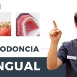 ortodoncia intralingual