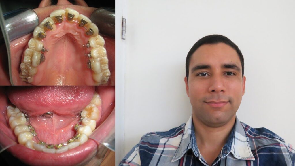 ortodoncia lingual antes y despues