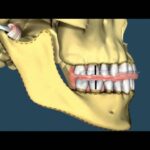 ortodoncia mandibula inferior retraida