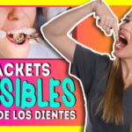 ortodoncia por dentro de los dientes