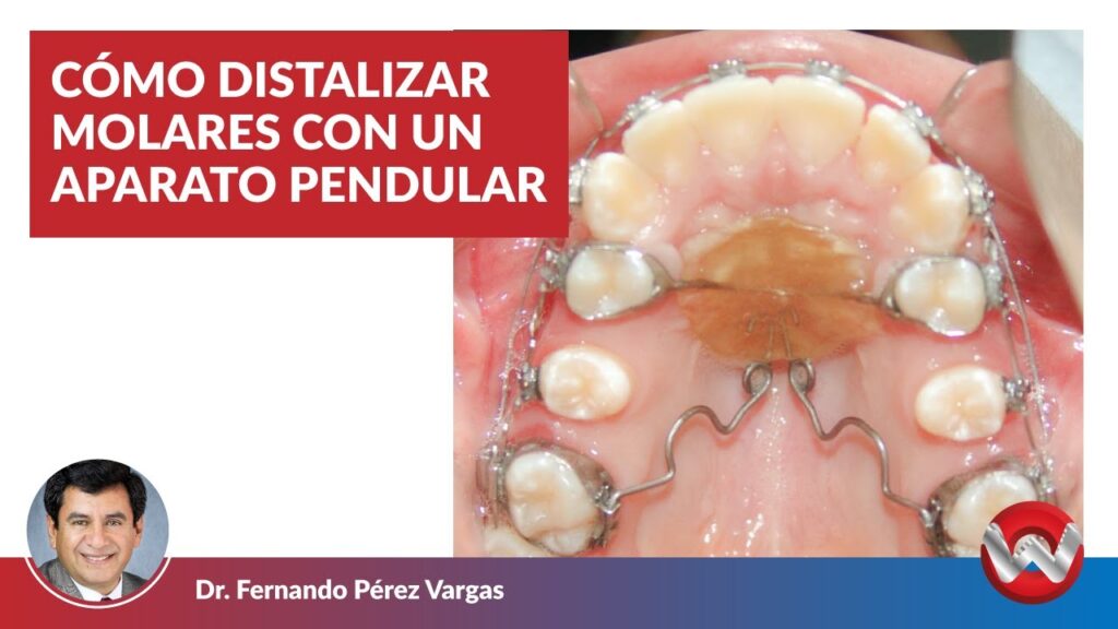 péndulo ortodoncia indicaciones y contraindicaciones