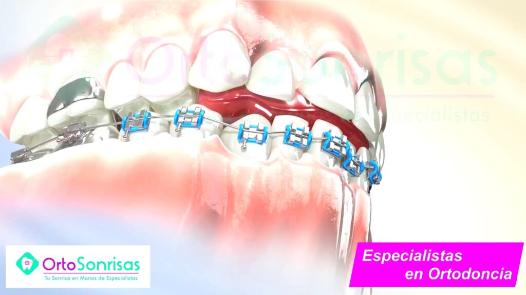 plano de mordida anterior ortodoncia