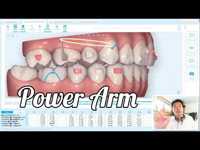 power arm ortodoncia