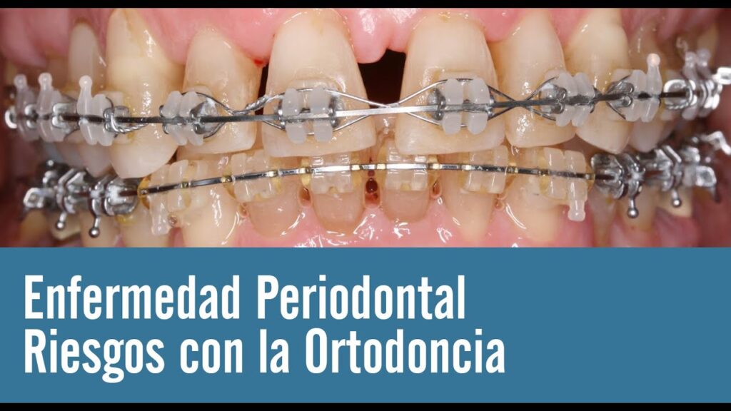 problemas periodontales ortodoncia