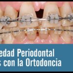 problemas periodontales ortodoncia