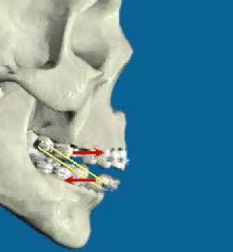 prognatismo mandibular ortodoncia