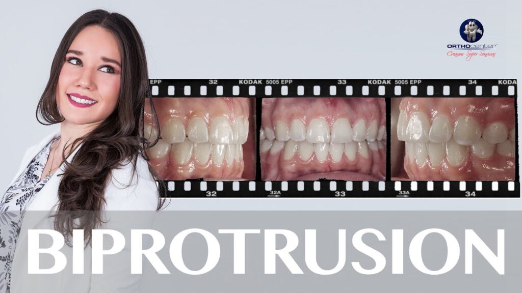 protrusion dental ortodoncia