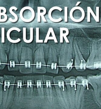 reabsorcion de raices por ortodoncia