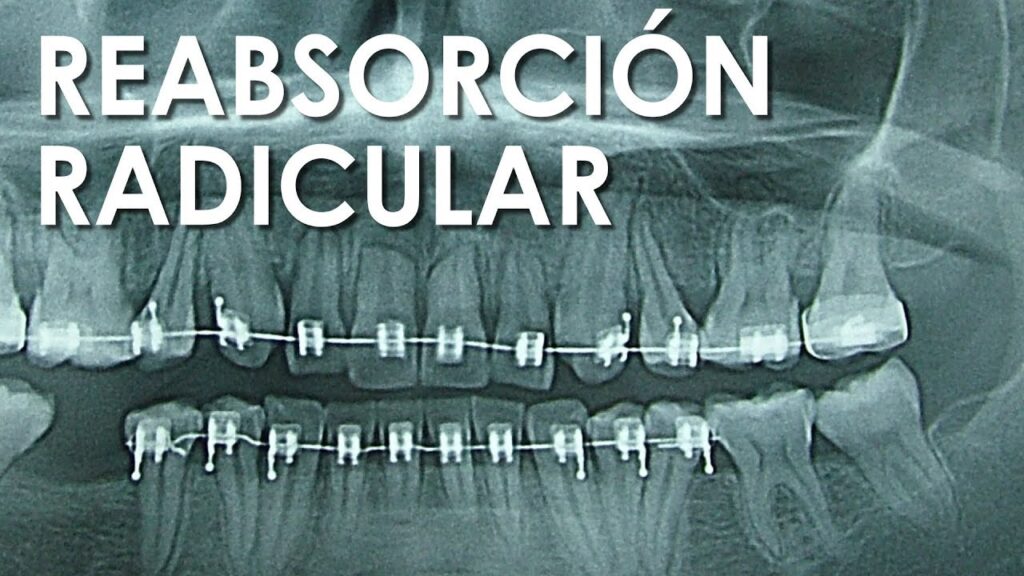 reabsorcion dental por ortodoncia