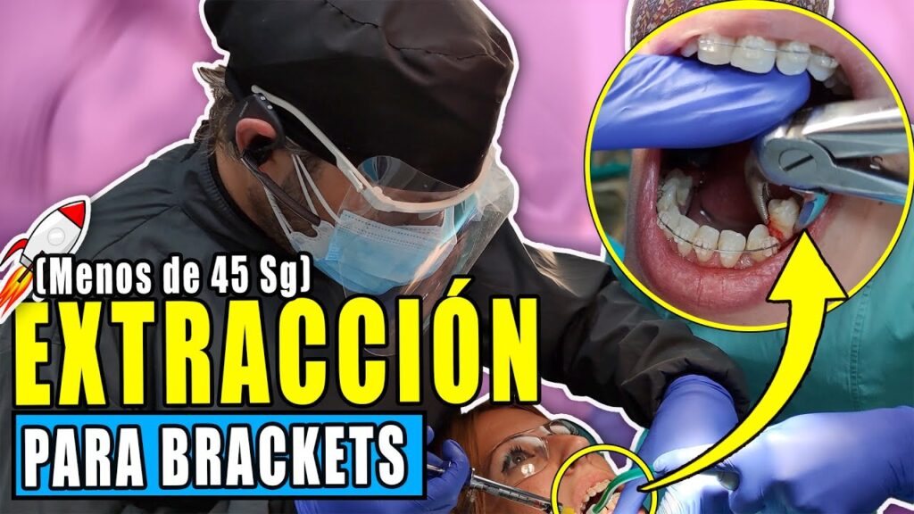 sacar premolares para ortodoncia