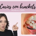 se puede poner ortodoncia con caries