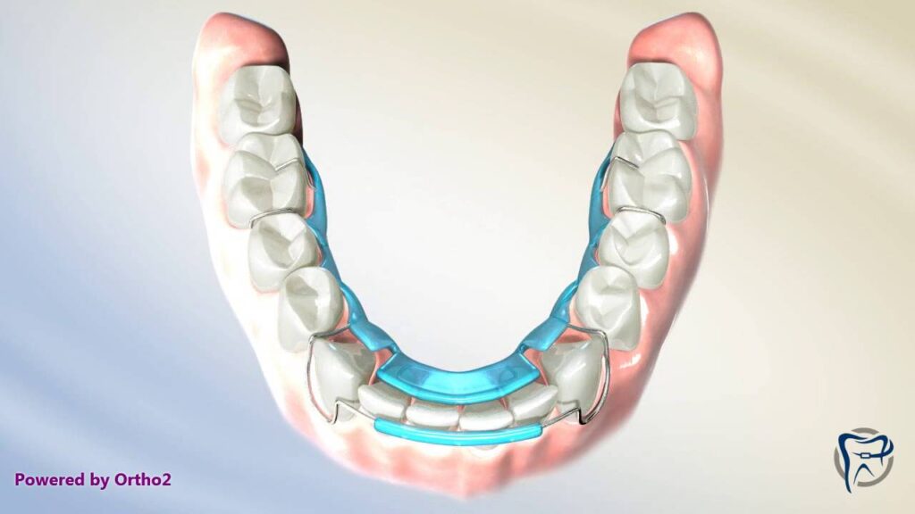 spring retainer ortodoncia