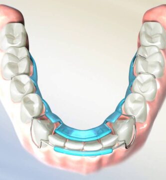 spring retainer ortodoncia