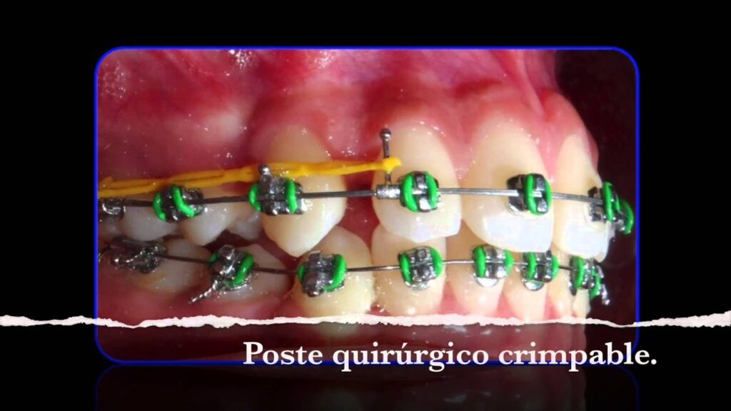 tip dental ortodoncia