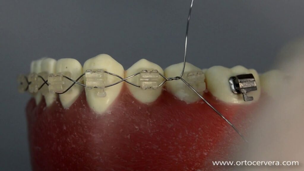 tipos de ligaduras en ortodoncia