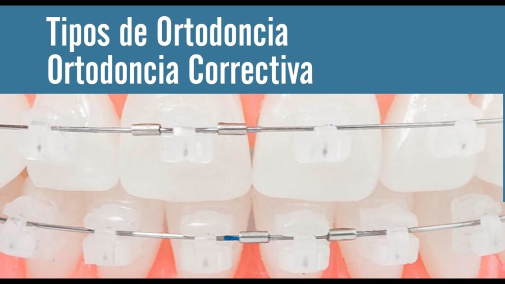 tipos de ortodoncia correctiva