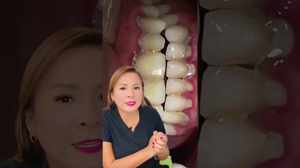 tratamiento de ortodoncia en pacientes con periodontitis agresiva